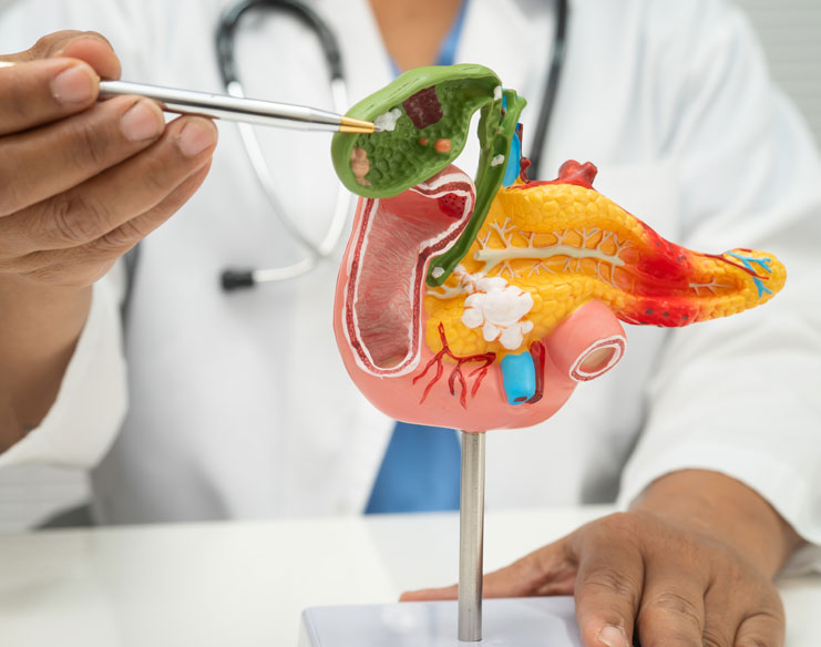 Do You Really Need Surgery to Remove Gallstones?