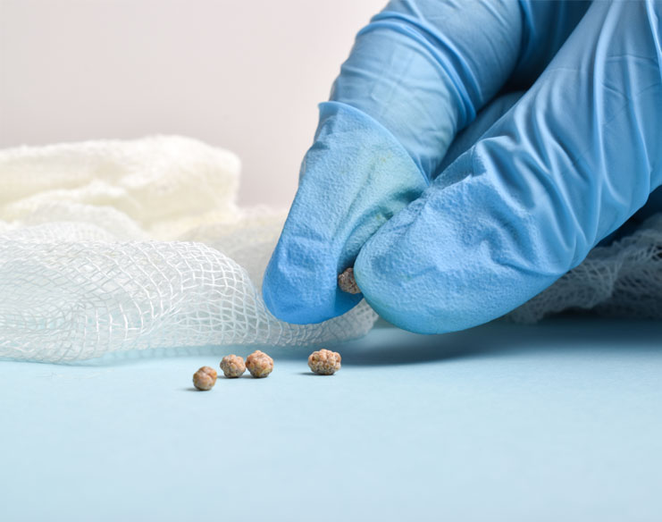 How to Prevent Gallstones: Tips for a Healthy Gallbladder