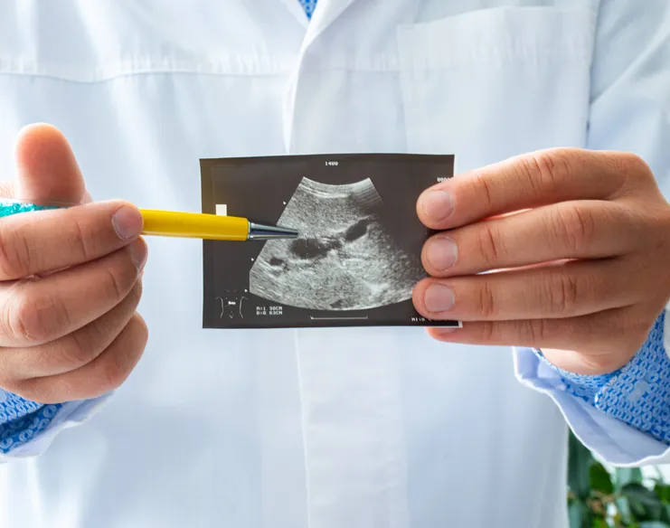 Doctor holding up an ultrasound scan of the gallbladder